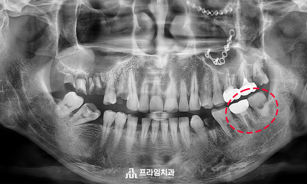 완산구임플란트