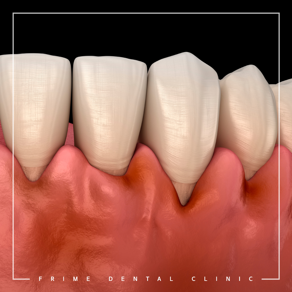 최소침습 임플란트