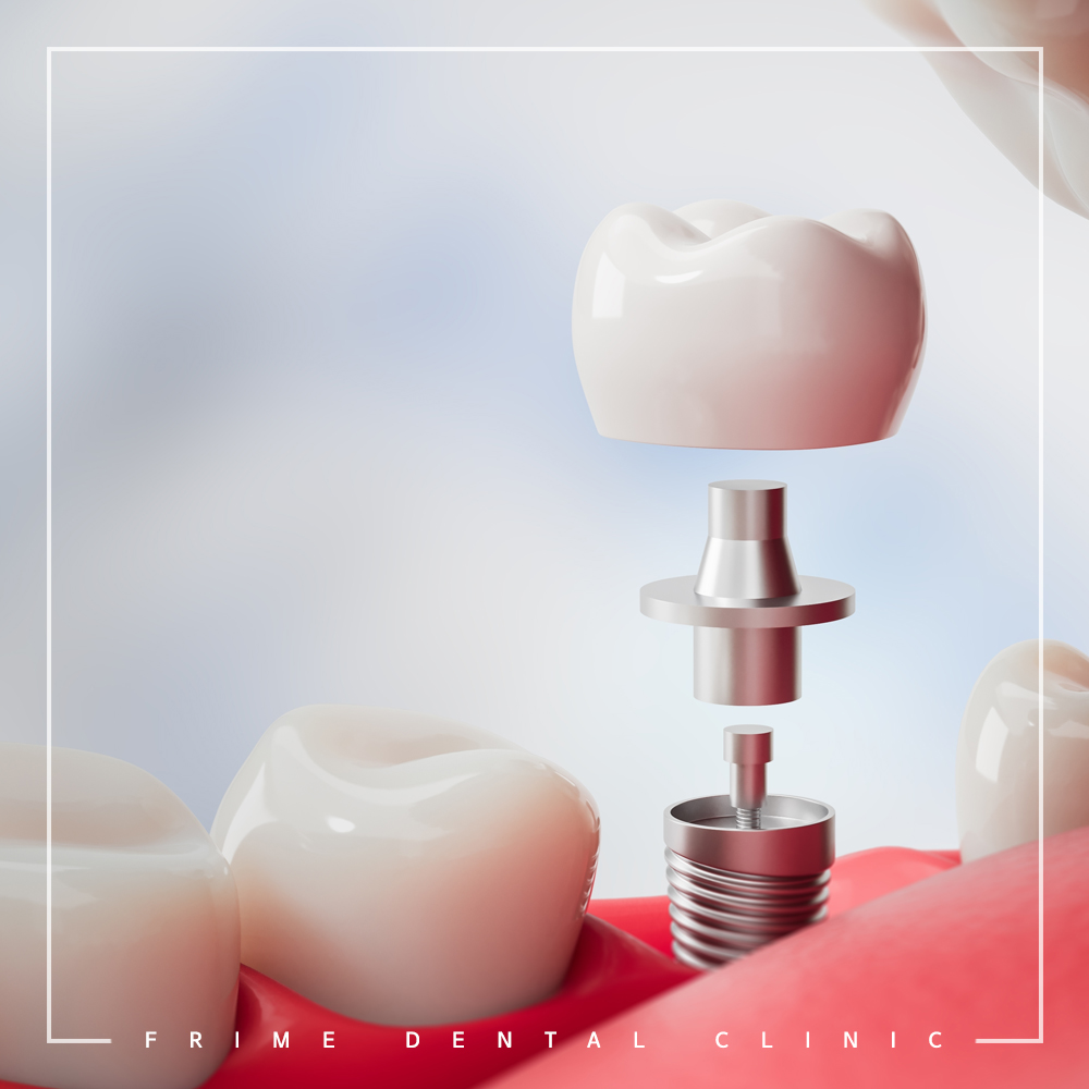 최소침습 임플란트