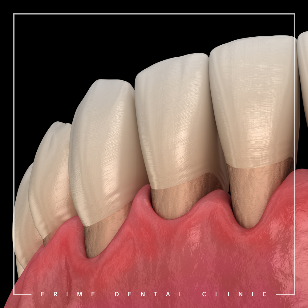 최소침습 임플란트