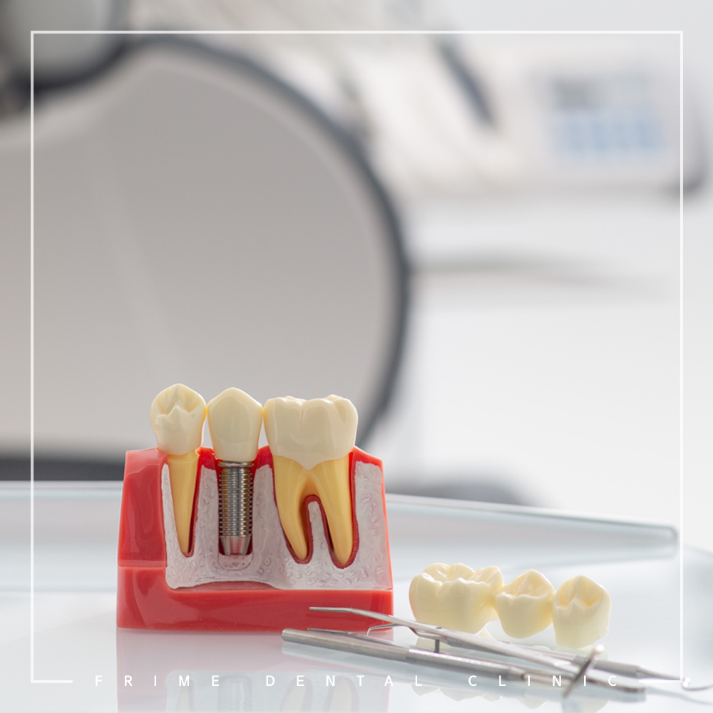 최소침습 임플란트