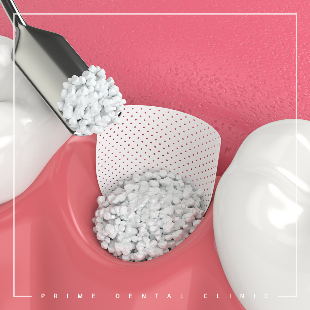 최소침습임플란트