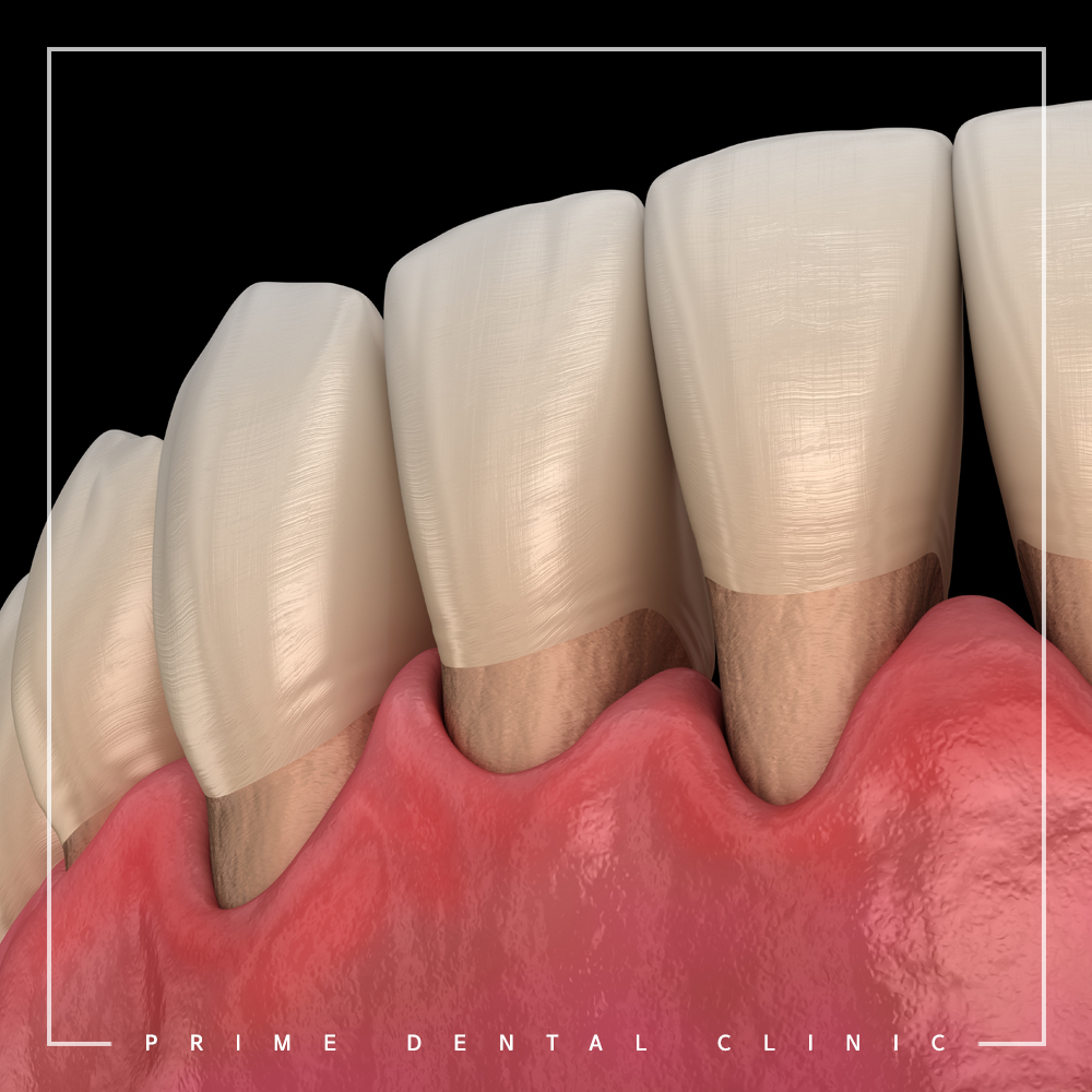 완산구임플란트