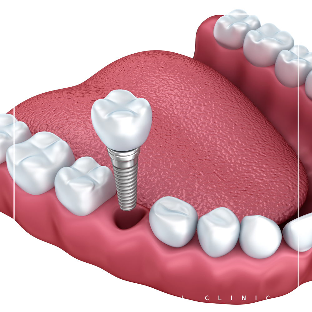 최소침습임플란트