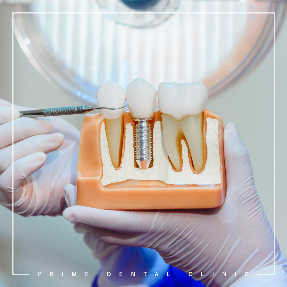 최소침습임플란트