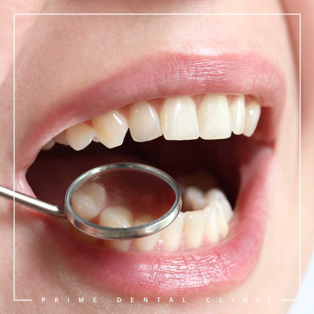 최소침습임플란트