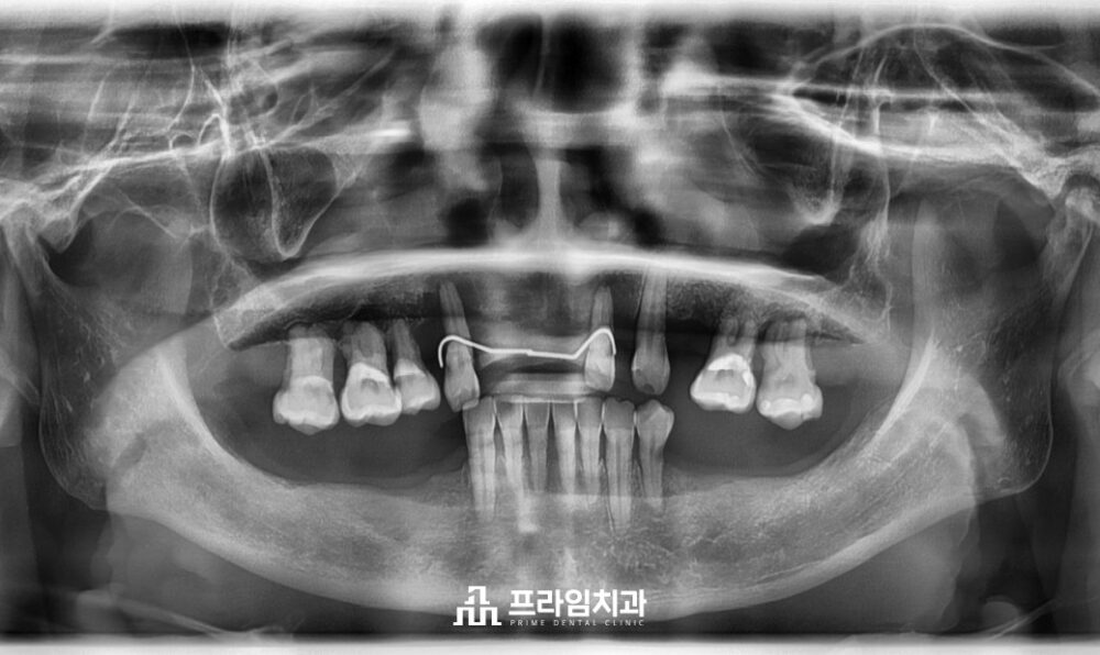 최소침습임플란트잘하는치과