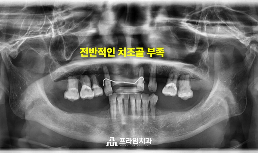 최소침습임플란트잘하는치과