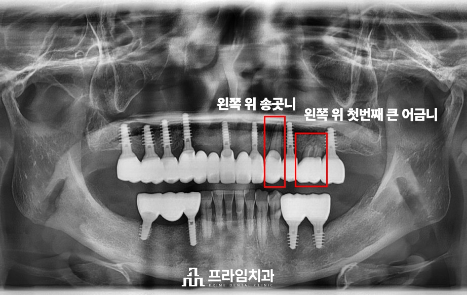 최소침습임플란트잘하는치과