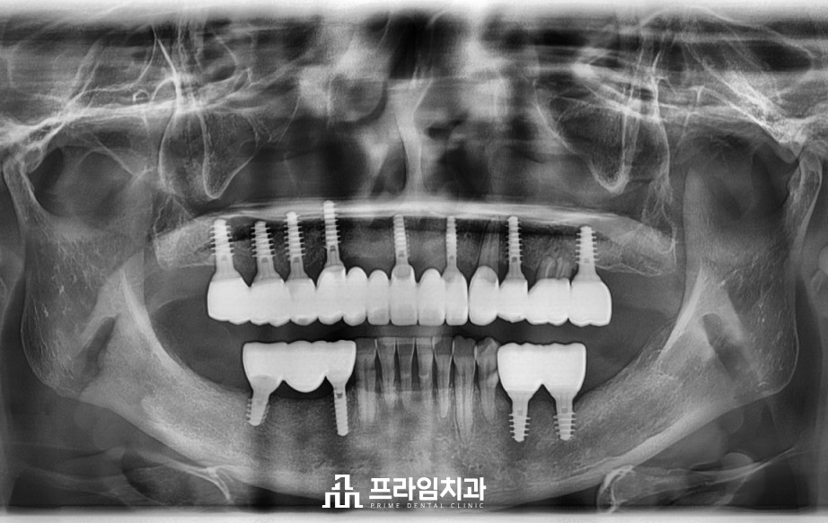 최소침습임플란트잘하는치과